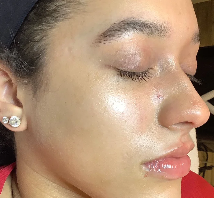 Lips after enhancement at Back to 30
