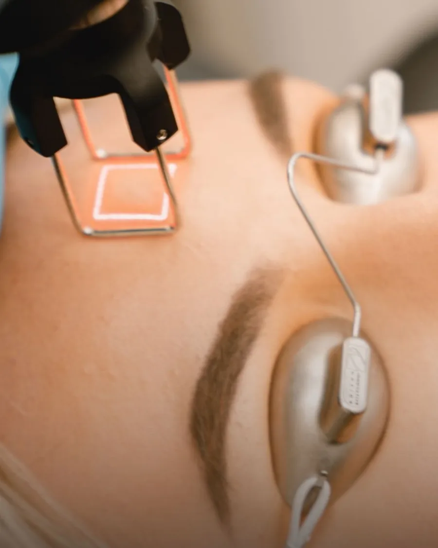 CO2 Laser at Back to 30 Med Spa
