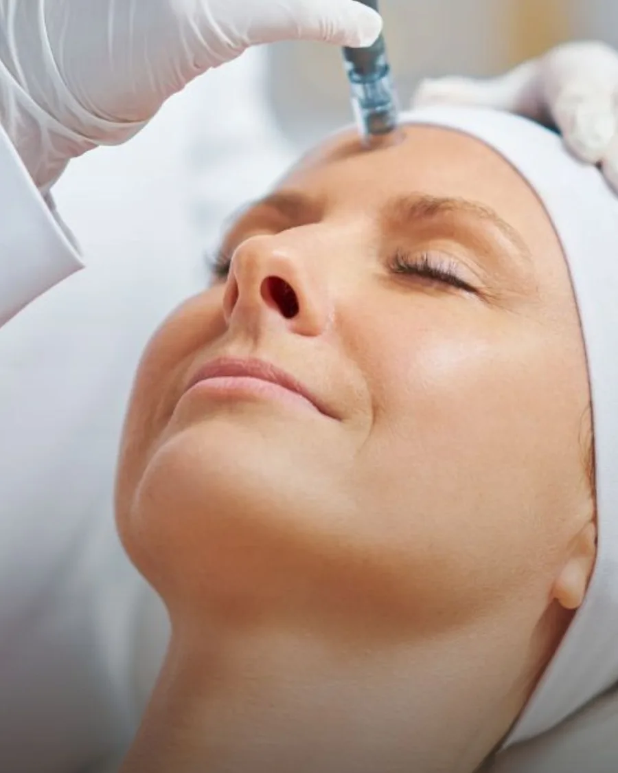 Microneedling at Back to 30 Med Spa