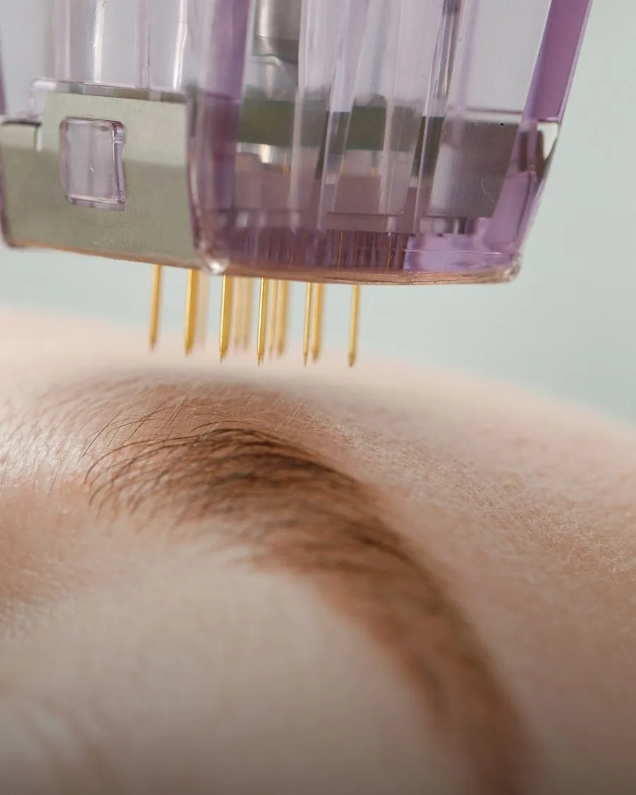 Morpheus8 at Back to 30 Med Spa