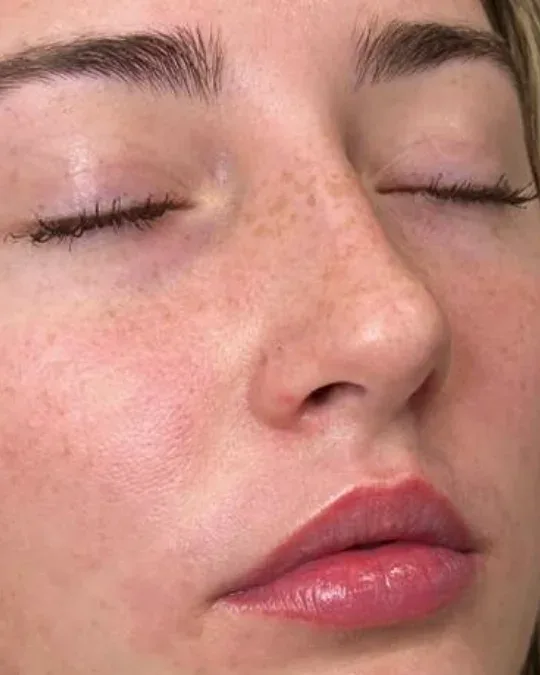 Lips before enhancement