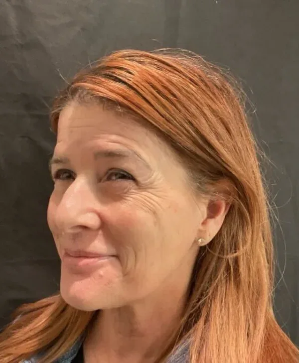 Skin before DiamondGlow and Botox