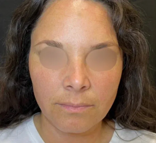 Face before facial balancing