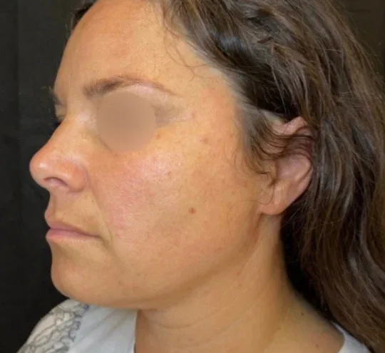 Profile before facial balancing