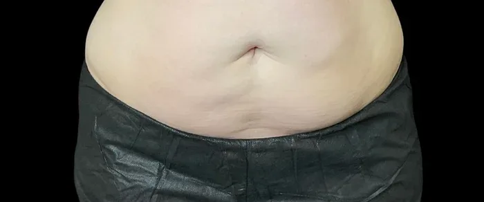 Abdomen before CoolSculpting