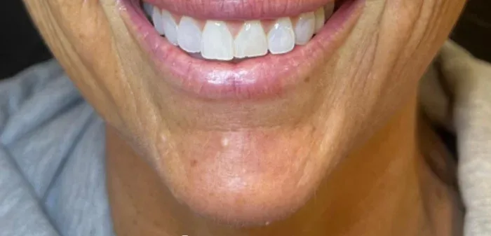 Lips before lip filler