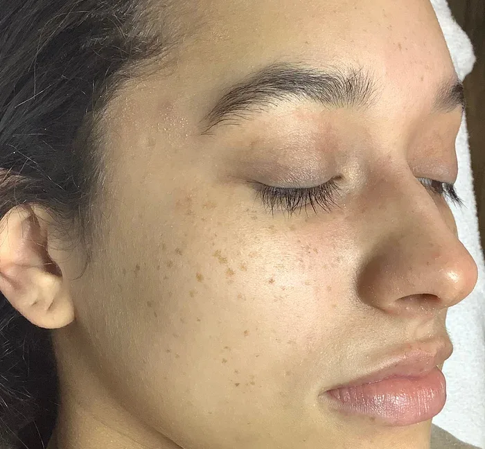 Sun damage before IPL