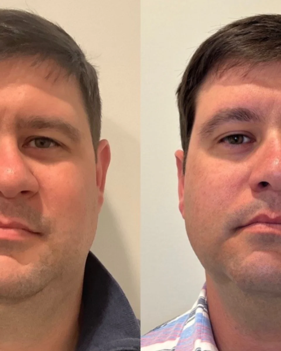 Back to 30 treatment results