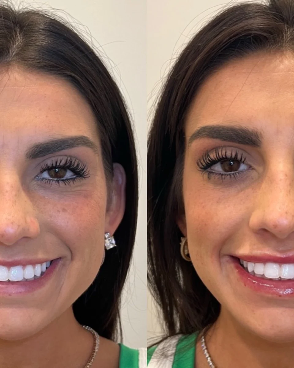 Back to 30 treatment results
