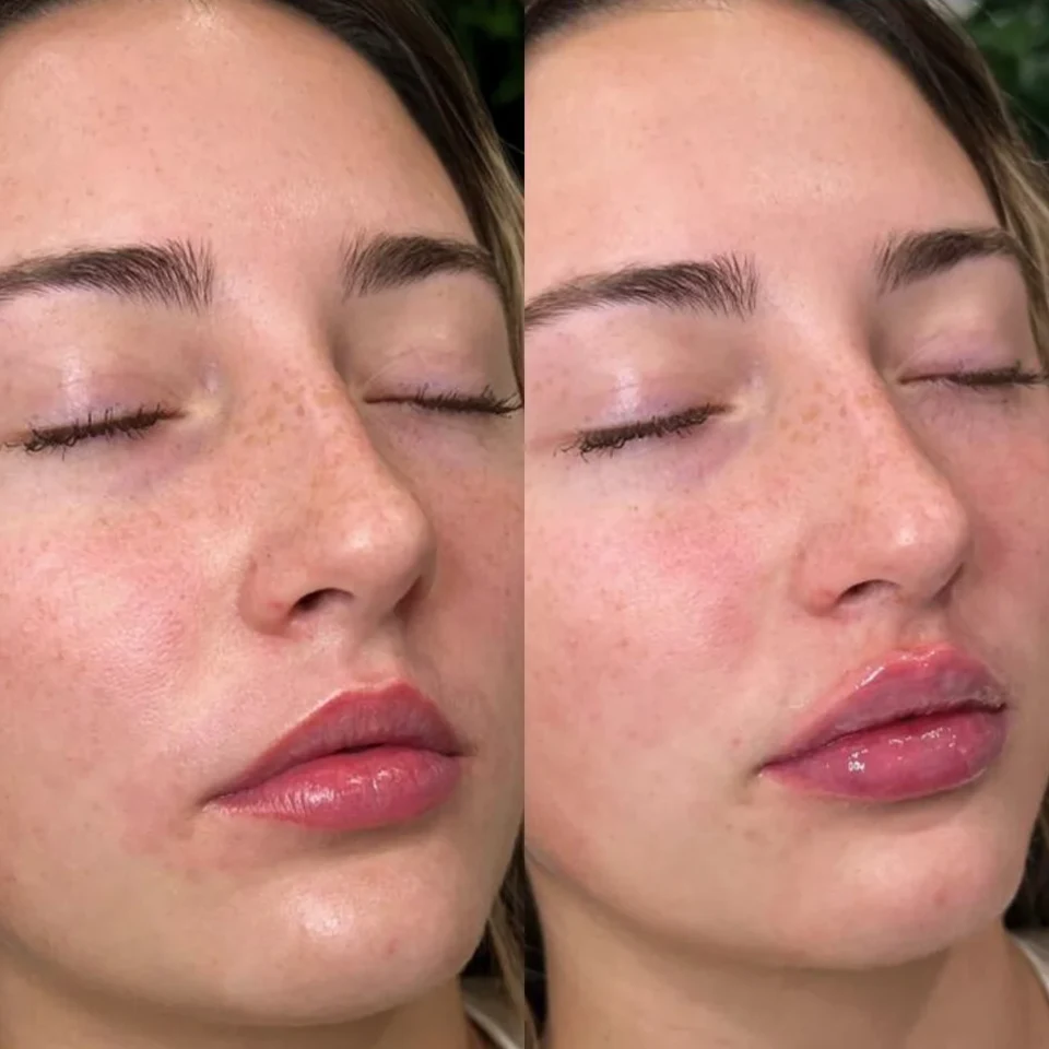 Back to 30 treatment results