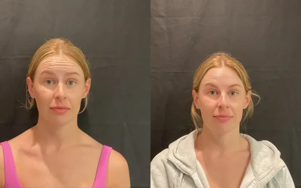 Side-by-side before and after portraits of a Dysport patient