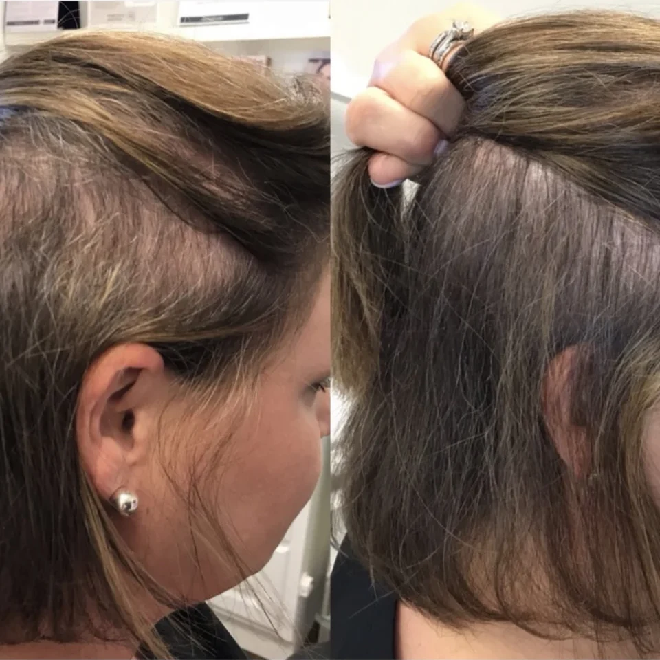 A Back to 30 patient in Upstate South Carolina